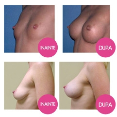 breastfast - pareri si rezultate